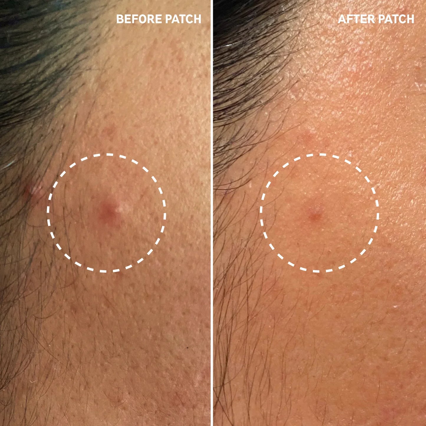 SKINNY Pimple Patch Kit